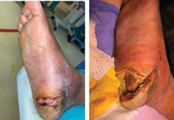 Before and after debridement - SingHealth Duke-NUS Vascular Centre