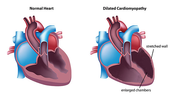 normal heart vs dilated cardiomyopathy