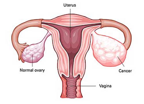 ovarian cancer conditions & conditions