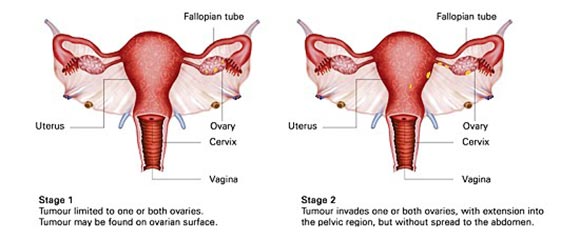 stages of ovarian cancer