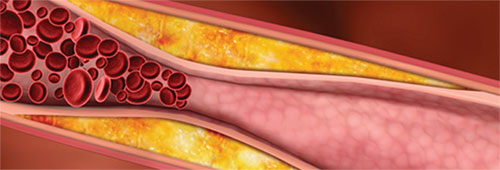illustration coronary artery narrowing