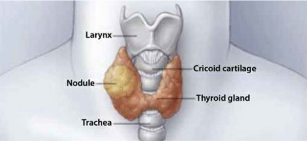 thyroid cancer conditions & treatments