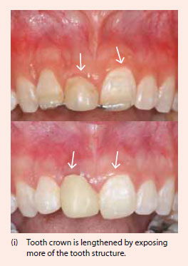 Gum surgery to lengthen tooth crown - National Dental Centre Singapore