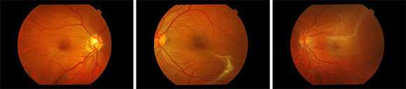 epiretinal membrane conditions & treatments