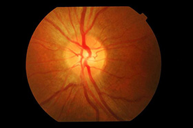 optic neuritis - resolution of left optic disc swelling<br/>in the same patient two weeks later