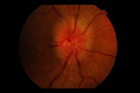 optic neuritis condition treatment - swollen right optic disc