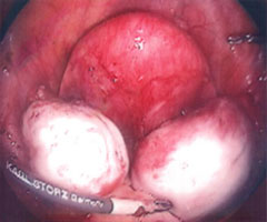 ovarian cysts or endometrioma