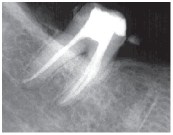 X-ray of a root filled tooth, according to the National Dental Centre Singapore
