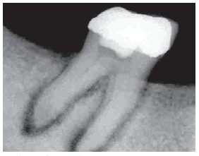 X-ray showin inflammation at the root tips, according to the National Dental Centre Singapore