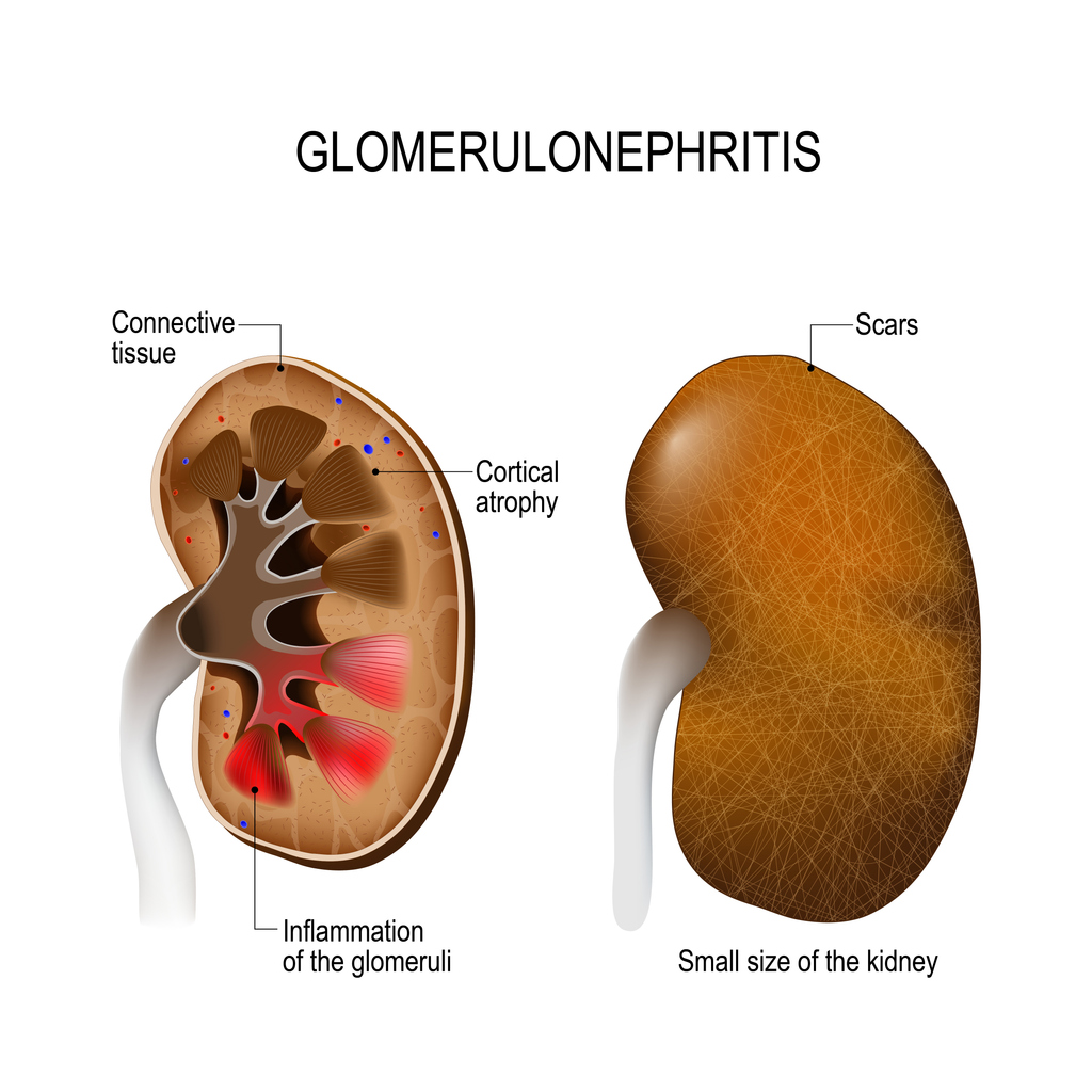 signs of Glomerulonephritis