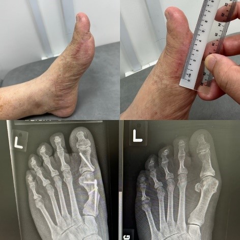 A new minimal incision percutaneous method for bunions - SKH